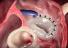 Abbott agrees to global transcatheter litigation settlement with Edwards Lifesciences Abbott