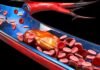 RapidAI could accelerate growth of thrombectomy procedures RapidAI