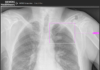 Siemens expands AI portfolio in the field of clinical decision-making AI
