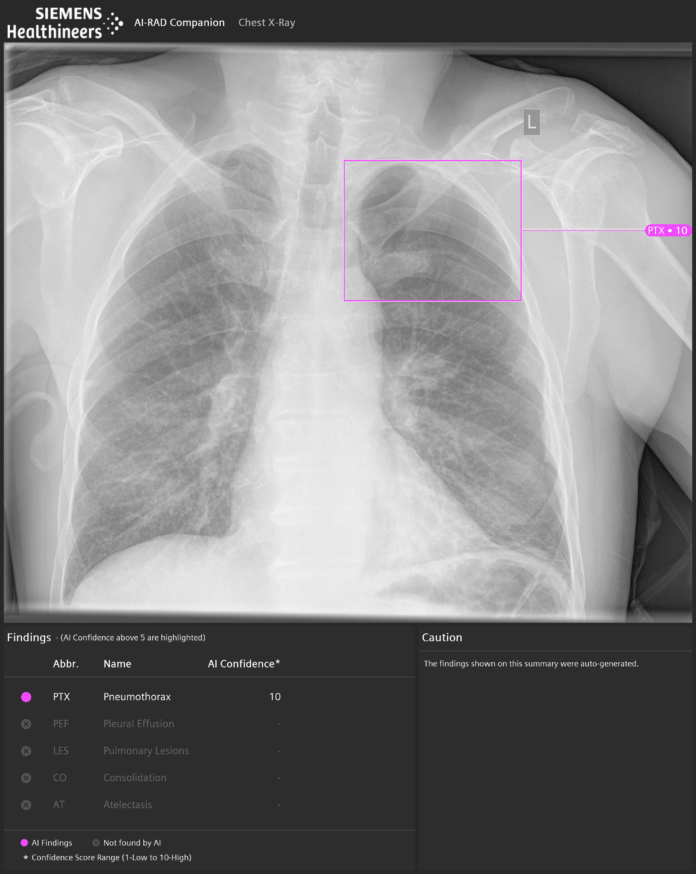 siemens-healthineers-press-chest-x-ray-of-a-patient-ai-rad-companion_download-07390490 AI