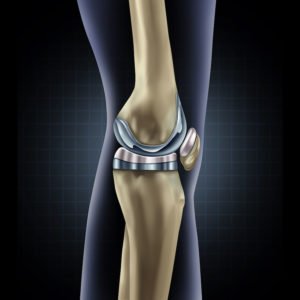 Knee Replacement knee Implants