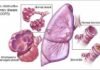 Glenmark introduces Nintedanib for treating Pulmonary Fibrosis in India Glenmark