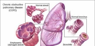 Glenmark introduces Nintedanib for treating Pulmonary Fibrosis in India Glenmark