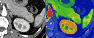 Spectral CT 7500 pancreatic lesion comparison Image Philips