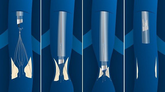 philips-cavaclear.download Philips received FDA De Novo Clearance for CavaClear, an IVC filter removal laser sheath