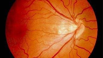 retinopathy-of-prematurity-1 Retinopathy