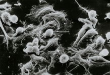 FDA approves first gene therapy for Metastatic Synovial Sarcoma FDA approves first gene therapy for Metastatic Synovial Sarcoma