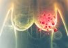 Breast cancer experts recommend annual mammograms Breast
