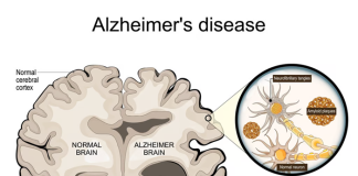 New discovery could offer significant answers on Alzheimer’s disease Alzheimer