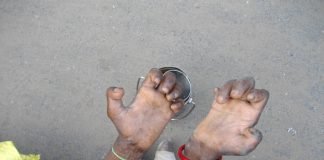 Leprosy day and public health — Promoting early diagnosis Leprosy