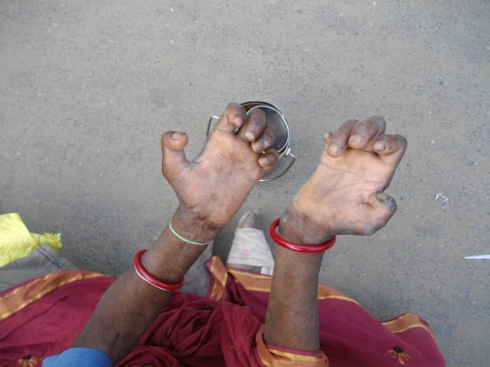 Leprosy patient begs for survival. Leprosy