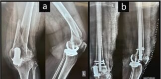 Not all need total knee replacement: Study knee