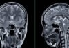 FDA clears new blood test for Alzheimer’s Alzheimer