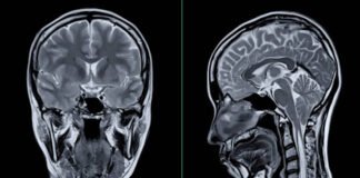 FDA clears new blood test for Alzheimer’s Alzheimer
