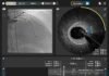 Philips agrees to acquire SpectraWAVE Inc Philips