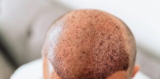 Top hair transplant surgeon sounds the alarm on India’s hair fall epidemic Hair