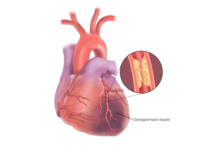 Coronary Coronary