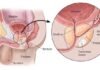 Microplastics discovered in prostate tumors prostate