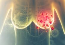 Standard radiotherapy treatment for breast cancer set to change Breast