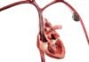 Philips launches new Bridge Plus Occlusion Balloon Philips
