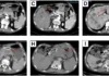 Phase II trial for gastric cancer treatment cancer