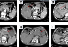 Phase II trial for gastric cancer treatment cancer