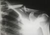 Bone fractures a concern for elderly, especially women Bone