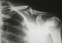 Bone fractures a concern for elderly, especially women Bone