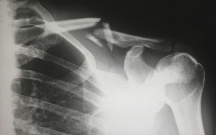 Bone Bone